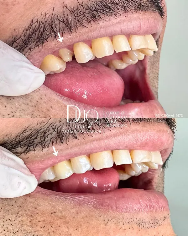 Tratamento de Reabilitação Oral com Coroa Prensada - Dentista Especialista na Duo Clínica