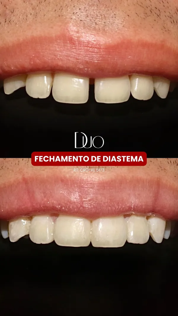 Estética Dental: Fechamento de Diastema realizado por dentistas especialistas