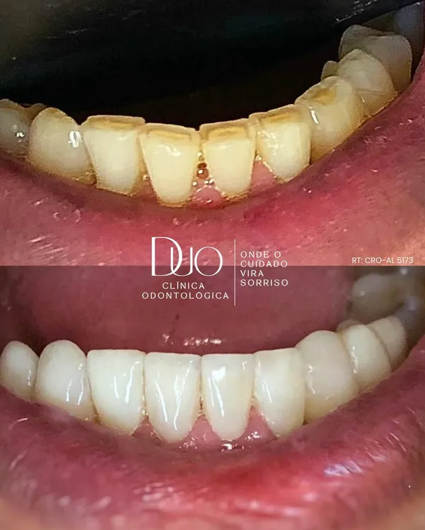 Resultado de Facetas em Resina Composta e Lentes de Contato Dental