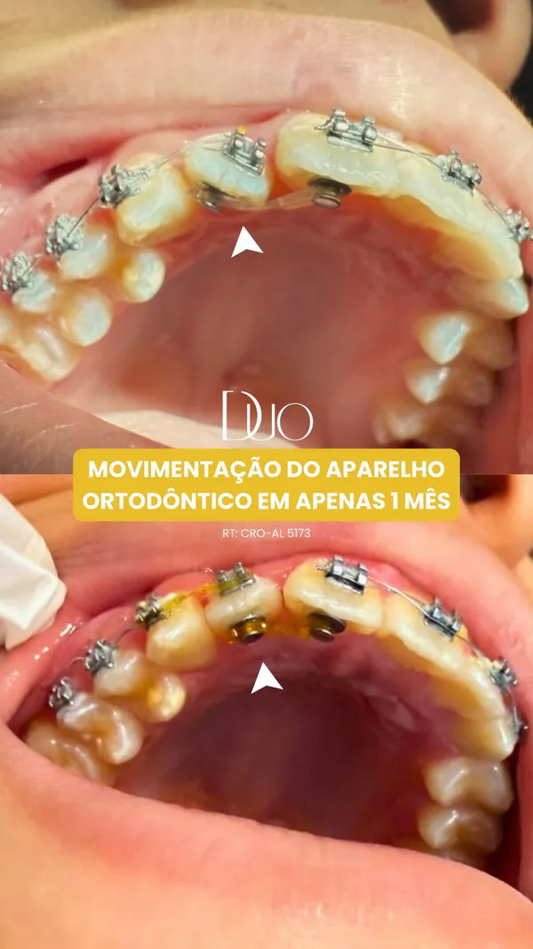 Resultado de Tratamento Ortodôntico Avançado com Aparelho Dental