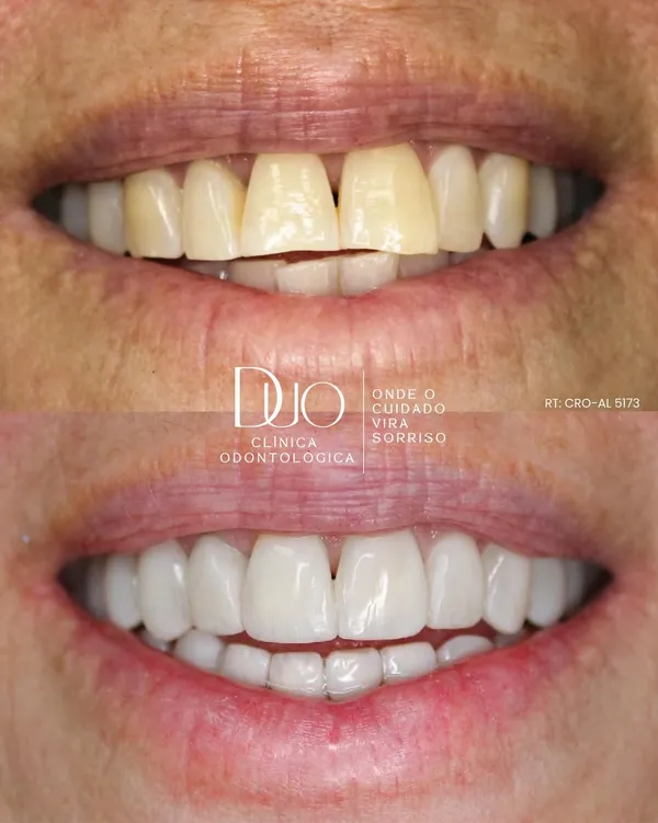 Antes e depois de Transformação Estética Dental avançada na Duo Clínica Odontológica